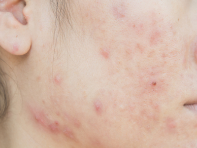 青春痘
