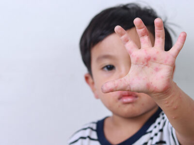 小兒濕疹