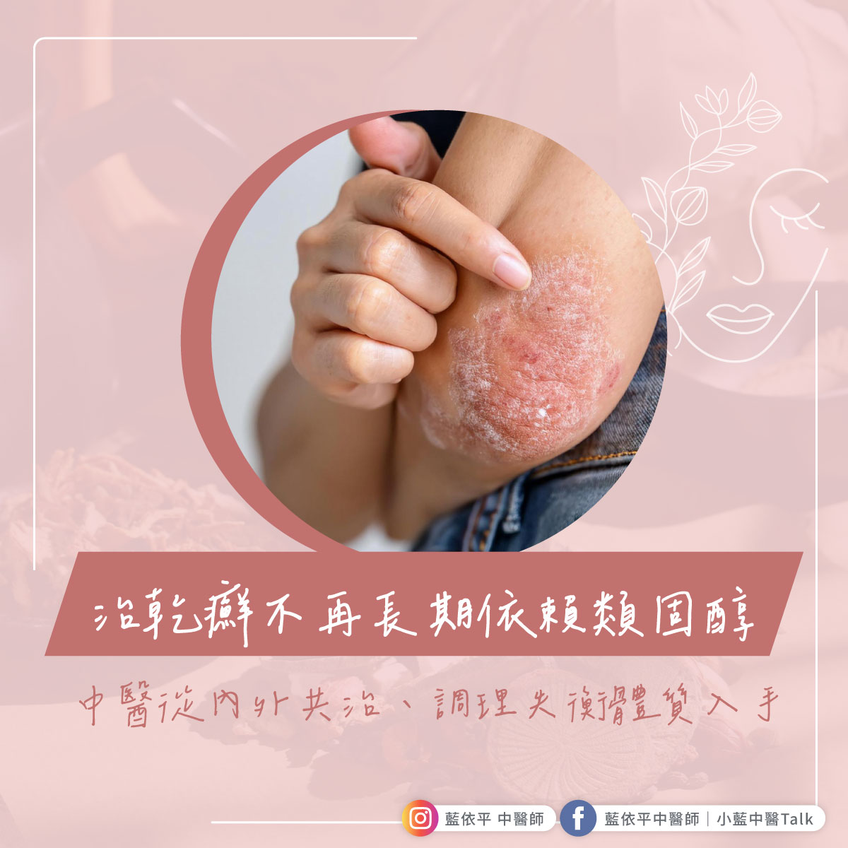 治乾癬不再長期依賴類固醇 - 藍依平中醫師｜依心為你-小藍中醫師