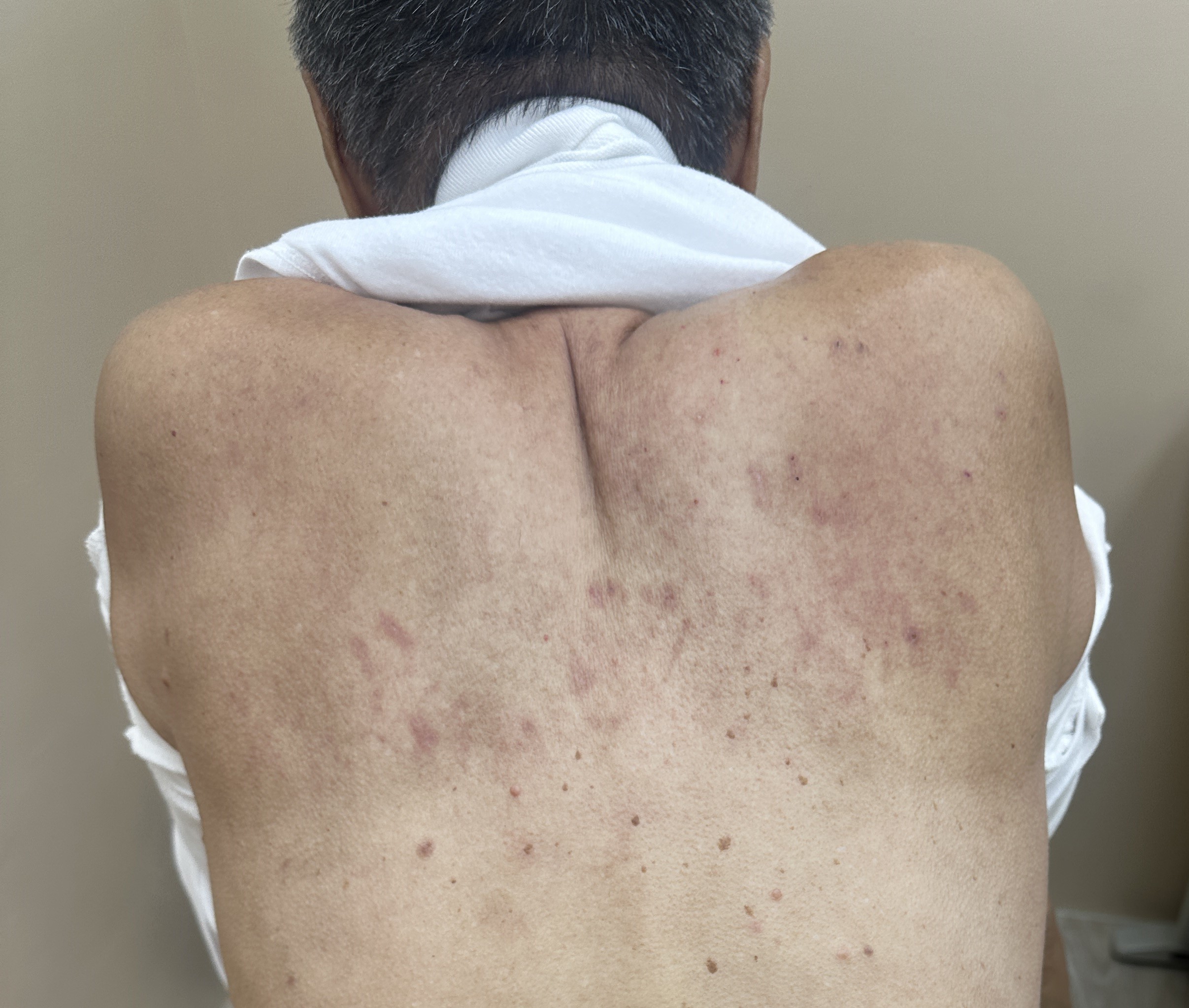 83 歲伯伯的蕁麻疹：1週中藥治療止癢退疹 - 藍依平中醫師｜依心為你-小藍中醫師