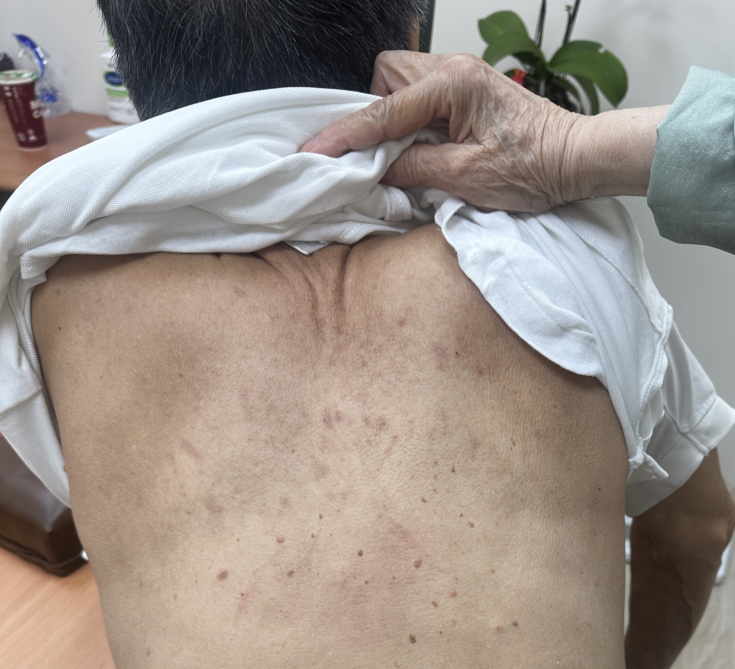 83 歲伯伯的蕁麻疹：1週中藥治療止癢退疹 - 藍依平中醫師｜依心為你-小藍中醫師