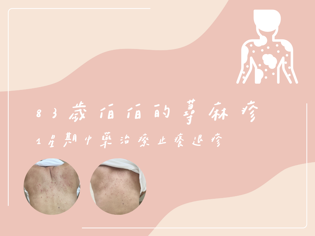 83 歲伯伯的蕁麻疹：1週中藥治療止癢退疹 - 藍依平中醫師｜依心為你-小藍中醫師